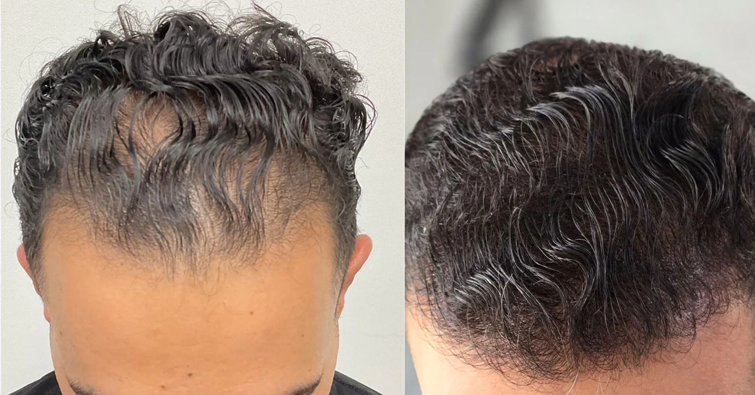 Résultat d'une greffe de cheveux : avant et après